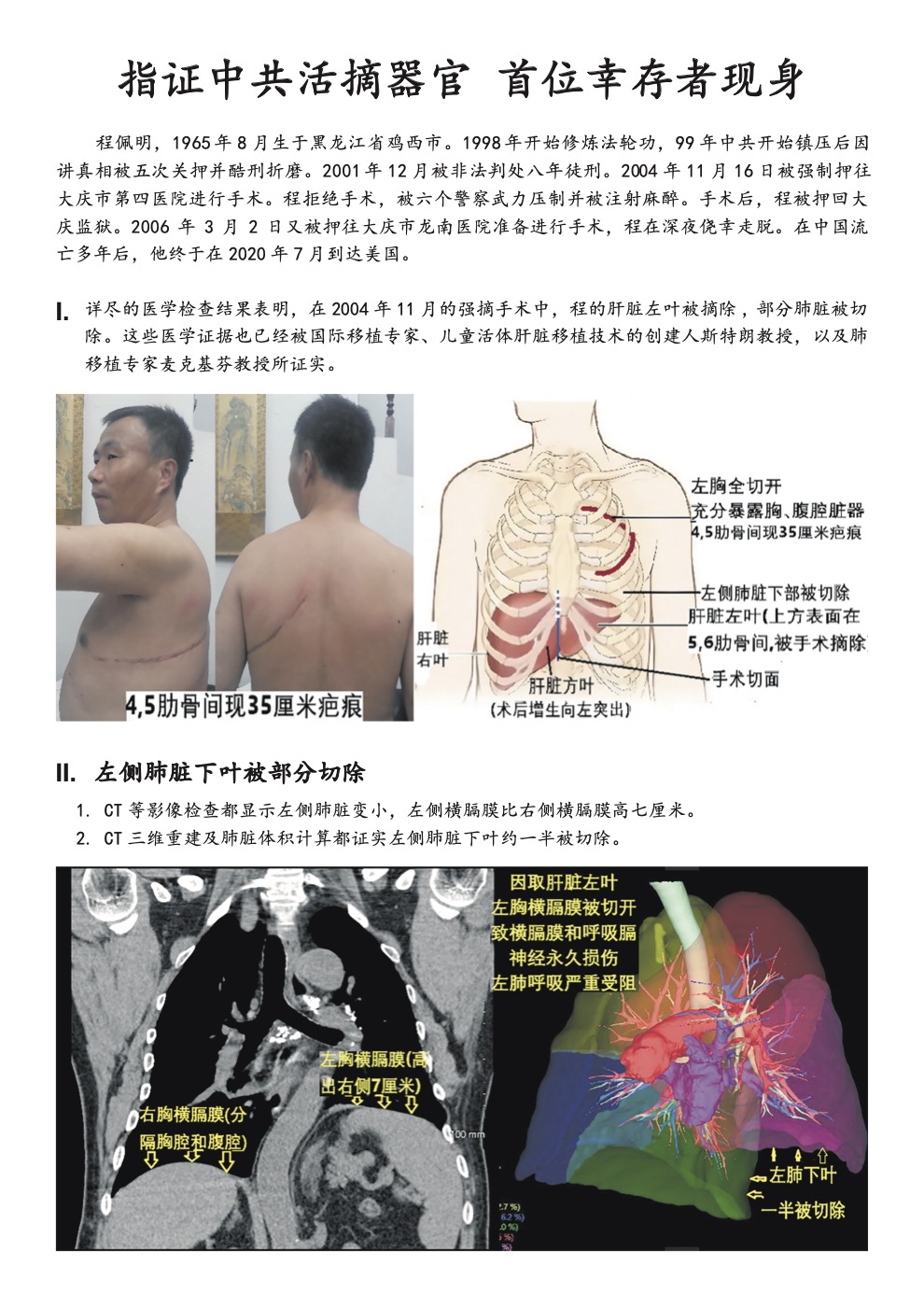 【真相传单】指证中共活摘器官 首位幸存者现身